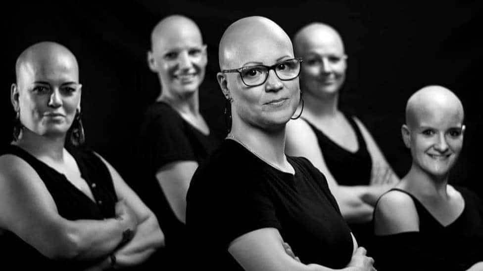 Alopecia femenina: contra el estigma de las mujeres calvas
